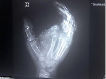 Ретгеновский снимок руки мальчика без пальца