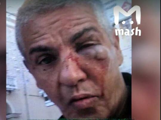 Избитый в России звезда «Такси» Насери может ослепнуть, — СМИ