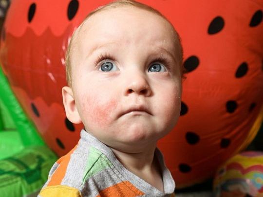 Британский мальчик родился с 50 видами аллергии — в том числе на собственные слезы и почти на всю еду