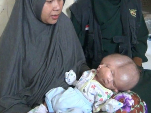 В Индонезии появился на свет ребенок с двумя лицами, но одной головой