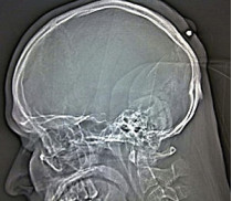 Немецкие врачи удалили из головы пациента пулю от огнестрельного оружия, с которой он прожил пять лет