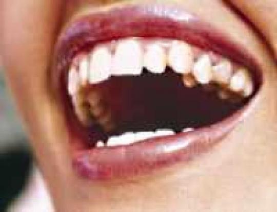 Домашние способы отбеливания зубов портят эмаль и десны 
