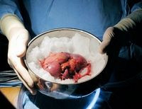 нелегальная трансплантация органов