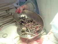 Мелитопольские хирурги, прооперировав 27-летнего пациента, извлекли больше килограмма (!) металлических предметов (фото)