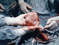 Первую в мире пересадку сердца, которое перестало биться задолго до трансплантации, осуществили австралийские кардиохирурги 