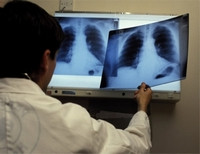 дефект грудной клетки рентген
