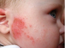 атопический дерматит у ребенка