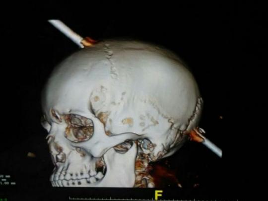 Рентгеновский снимок черепа, пробитого прутом