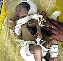 Индийские врачи борются за жизнь младенца, родившегося с сердцем, которое находится снаружи грудной клетки