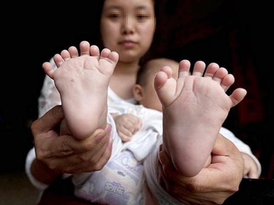 китаец с 31 пальцем на руках и ногах