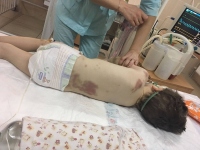 На Полтавщине медики борются за жизнь 4-летнего мальчика, избитого родителями до полусмерти