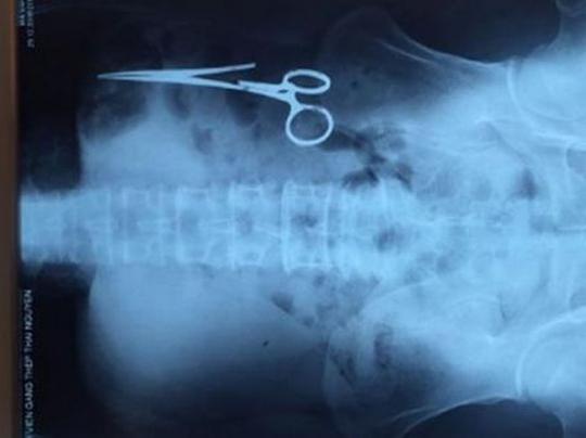 Вьетнамские врачи извлекли из живота пациента ржавые ножницы, забытые хирургами во время операции 18 лет назад 