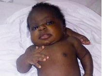 В США успешно прооперировали девочку, родившуюся с четырьмя ногами и двумя позвоночниками (фото)