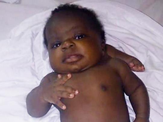 В США успешно прооперировали девочку, родившуюся с четырьмя ногами и двумя позвоночниками (фото)