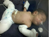Индийские врачи успешно удалили из живота новорожденного&#133; зародыш его брата-близнеца