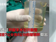 Китайские врачи извлекли из заднего прохода пациента стеклянный стакан диаметром семь сантиметров (фото)