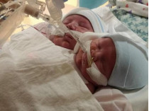 В американской семье, где уже есть пятеро детей, родились сиамские близнецы (фото)