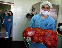 Врачи удалили с ягодицы 36-летней женщины опухоль, которая весила 45 килограммов&nbsp;— больше, чем сама пациентка
