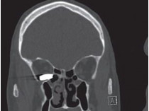 Рентгеновский снимок, на котором видна пуля в глазнице