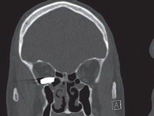 Рентгеновский снимок, на котором видна пуля в глазнице