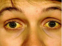 Пожелтевшие глаза пациента с гепатитом А