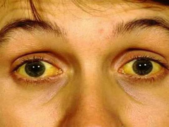Пожелтевшие глаза пациента с гепатитом А