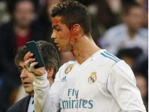 Криштиану Роналду прямо на поле рассматривал свое окровавленное лицо, взяв телефон у врача «Реала» (фото) 
