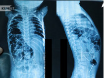 Рентгеновский снимок, на котором видны иглы