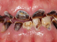 Ирландский любитель газировки ужаснул интернет снимками своих зубов (фото)