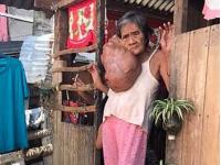 На лице филиппинки образовалась опухоль размером с ведро, но операцию она делать боится (фото, видео) 