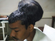 Индийские хирурги удалили самую большую в мире опухоль мозга (фото)