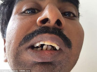 В Индии прооперировали мужчину, который 38 лет не мог открыть рот из-за "заклинившей" челюсти (фото)