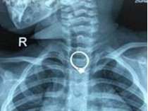 Рентгеновский снимок, на котором видно кольцо