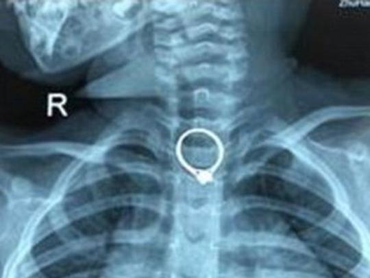 Рентгеновский снимок, на котором видно кольцо