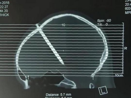 Рентгеновский снимок гвоздя в голове