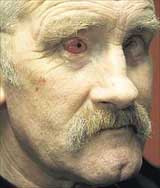 Чтобы восстановить жителю ирландии зрение, врачи вставили мужчине в глазницу&#133; Зуб его сына