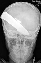 Британские врачи вытащили из головы 10-летнего афганского мальчика нож длиной 7,5 сантиметра