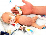 Месячному малышу, весившему при рождении 800 граммов, столичные медики устранили два порока сердца