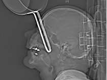 Рентгеновский снимок с ручкой от кастрюли в черепе