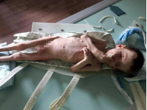 Изможденный ребенок из Новоукраинки