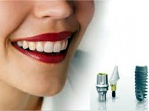 Современная имплантация зубов по доступным ценам