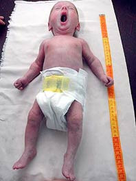 «роды у меня начались на четыре месяца раньше срока. Даже врачи удивились, что малышка сразу закричала, ведь весила она всего 460 граммов, а рост ее был 23 сантиметра! »