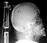 Американец, выстрелом из пневмомолотка случайно вогнавший себе в череп шестисантиметровый гвоздь, даже не почувствовал боли и остался абсолютно невредим