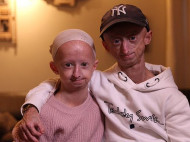 В Бельгии брат и сестра страдают редчайшим генетическим заболеванием, вызывающим преждевременное старение (фото)