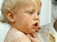 Корь в Украине: чем невакцинированный ребенок опасен для вакцинированного