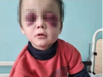 Глаза не открывались из-за гематом: подробности страшного избиения 6-летнего мальчика под Винницей (фото)