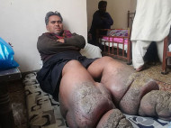 Пакистанец заболел слоновьей болезнью после укуса комара (ужасающие фото)
