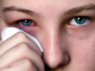 Красный глаз — симптом многих заболеваний, требующих серьезного лечения
