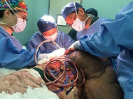 Уродливый нарост: китайцу удалили огромную опухоль в полспины весом 15 кг (фото не для слабонервных)