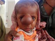 В Пакистане родился ребенок с мозговой грыжей на лице (шокирующие фото)